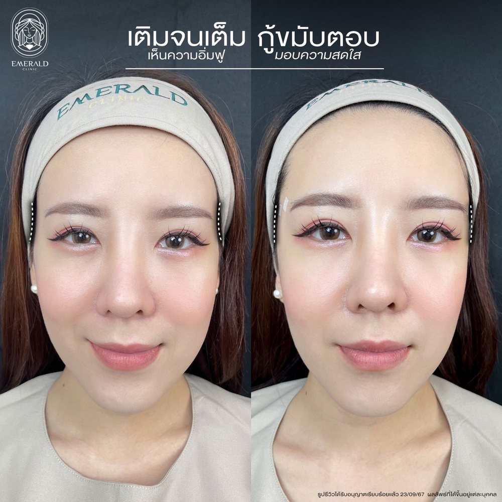 Temple filler, before and after