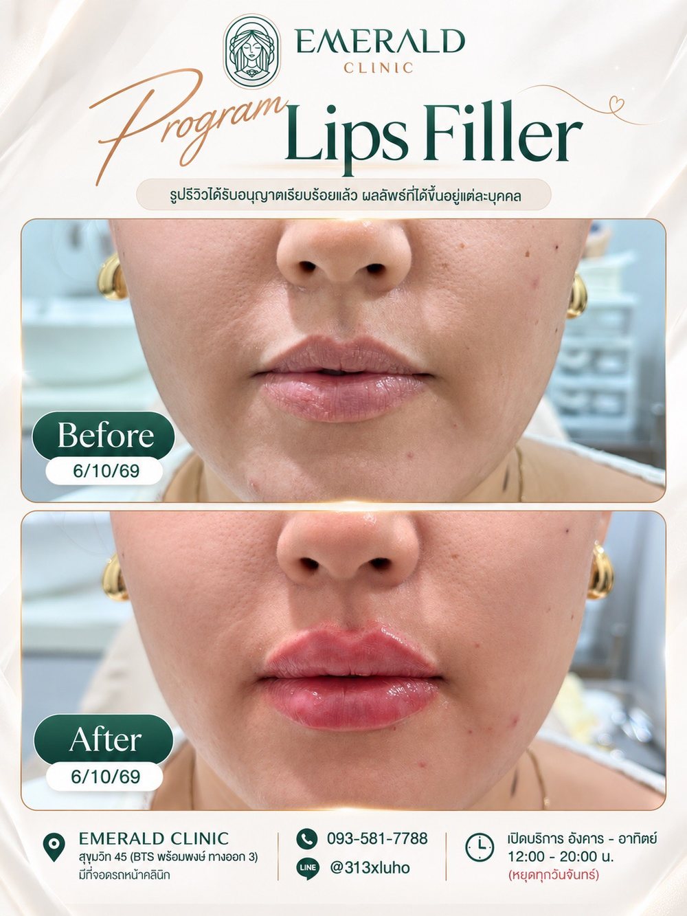 Lip filler, before and after