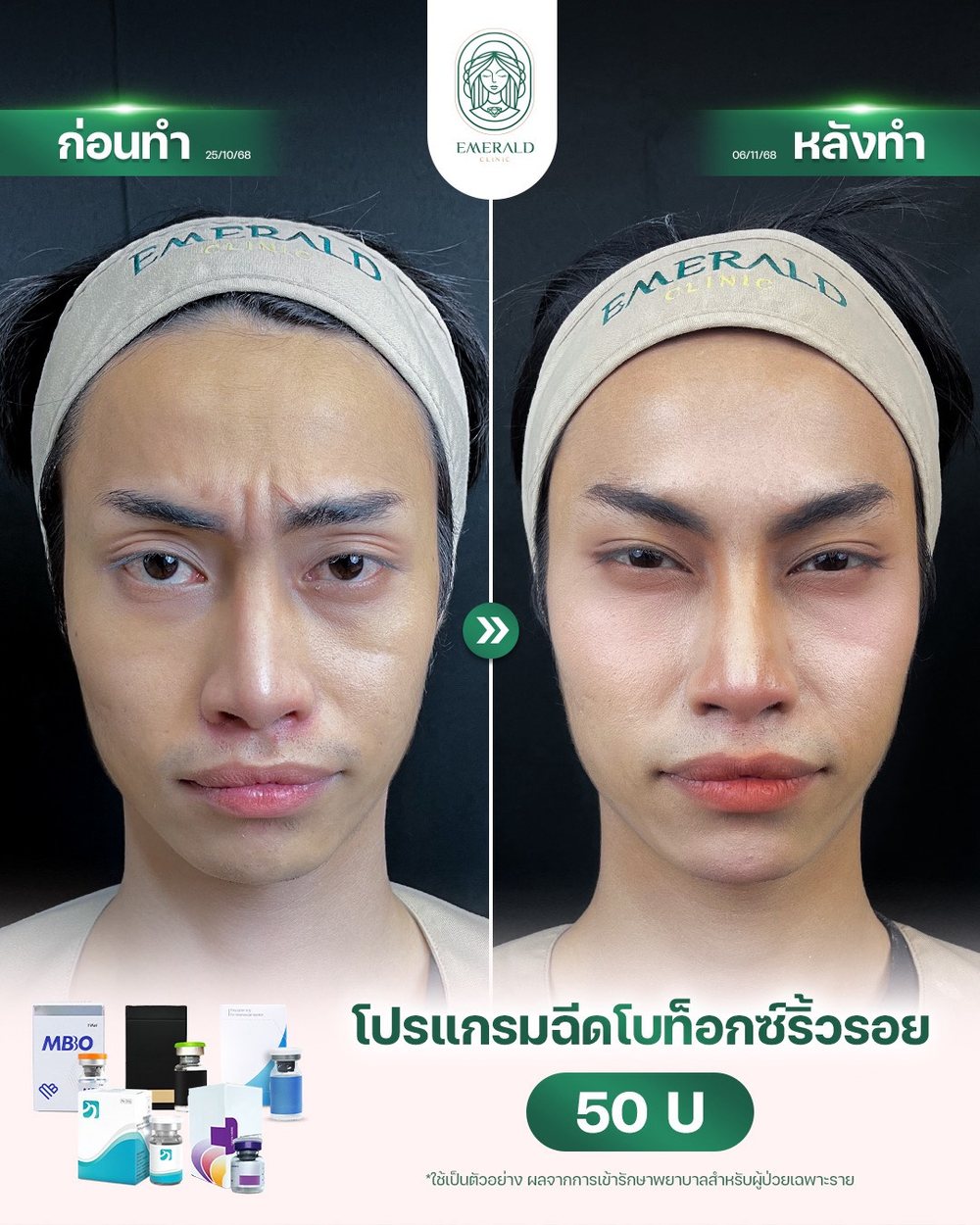 Botox for wrinkles, before and after