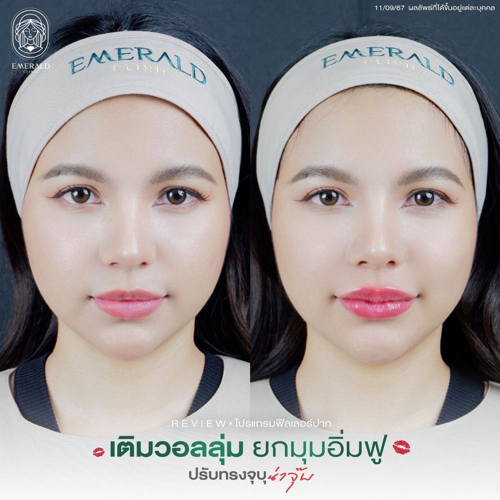 Lip filler, before and after