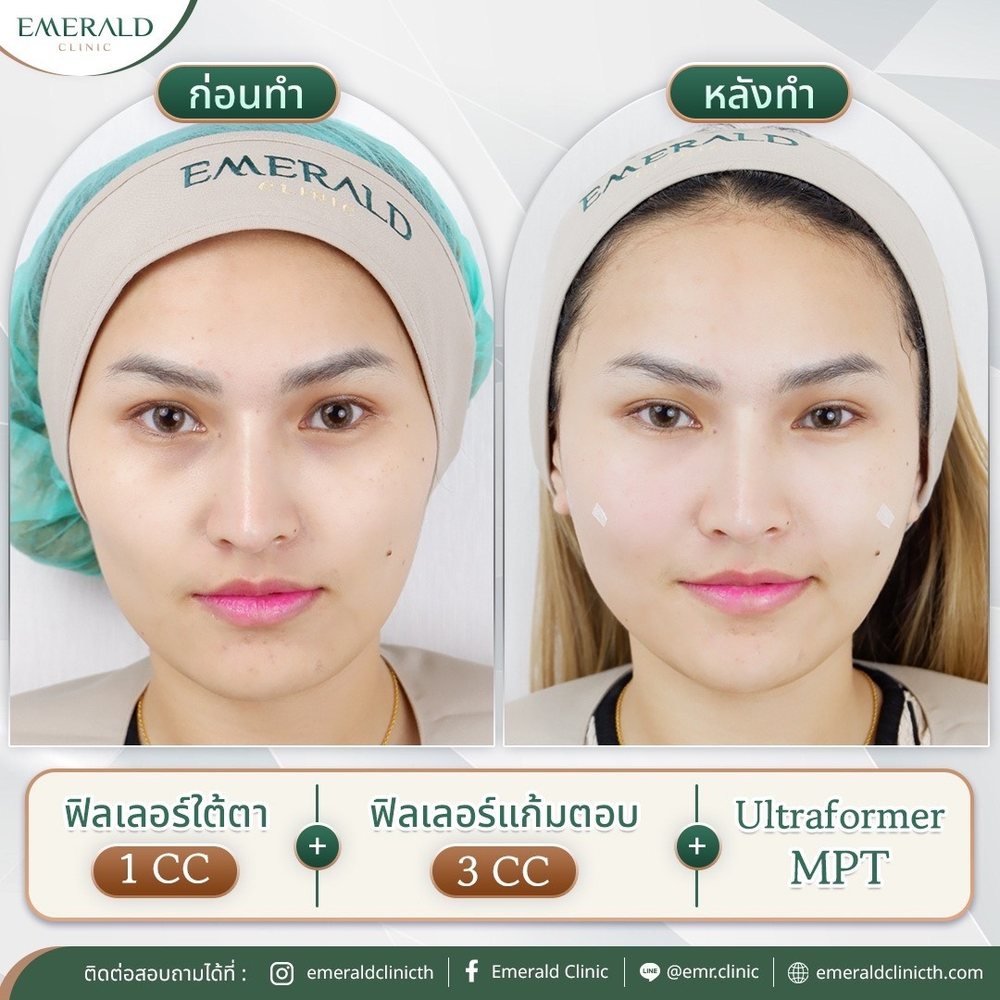 Under-eye and cheek filler with Ultraformer MPT, before and after